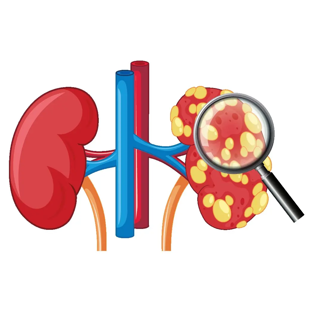 Kidney Cancer (Renal Cell)