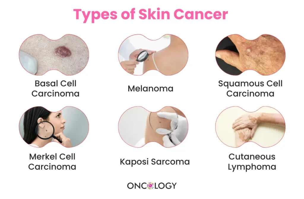 Skin Cancer Treatment in Chennai
