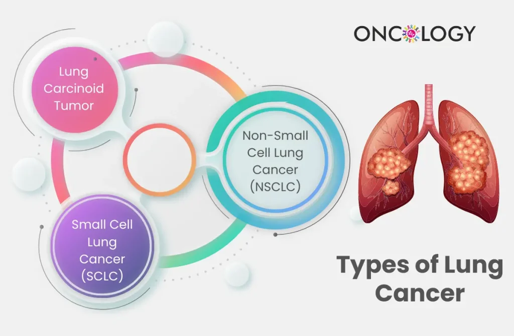 Best Lung Cancer Treatment In Chennai