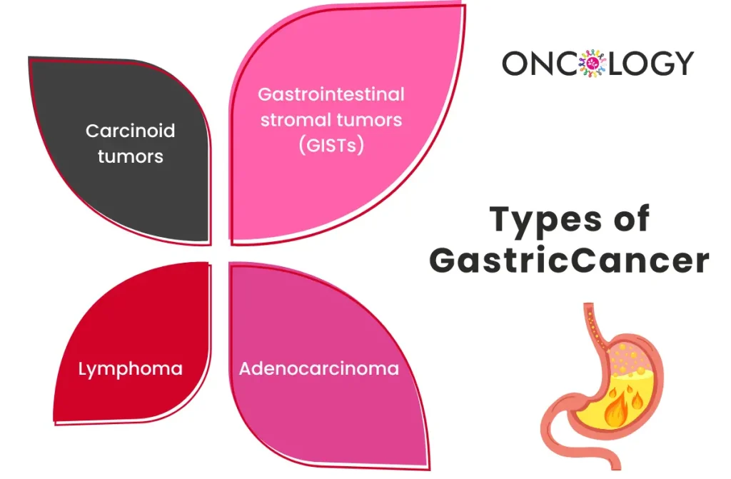 Gastric Cancer Treatment in Chennai