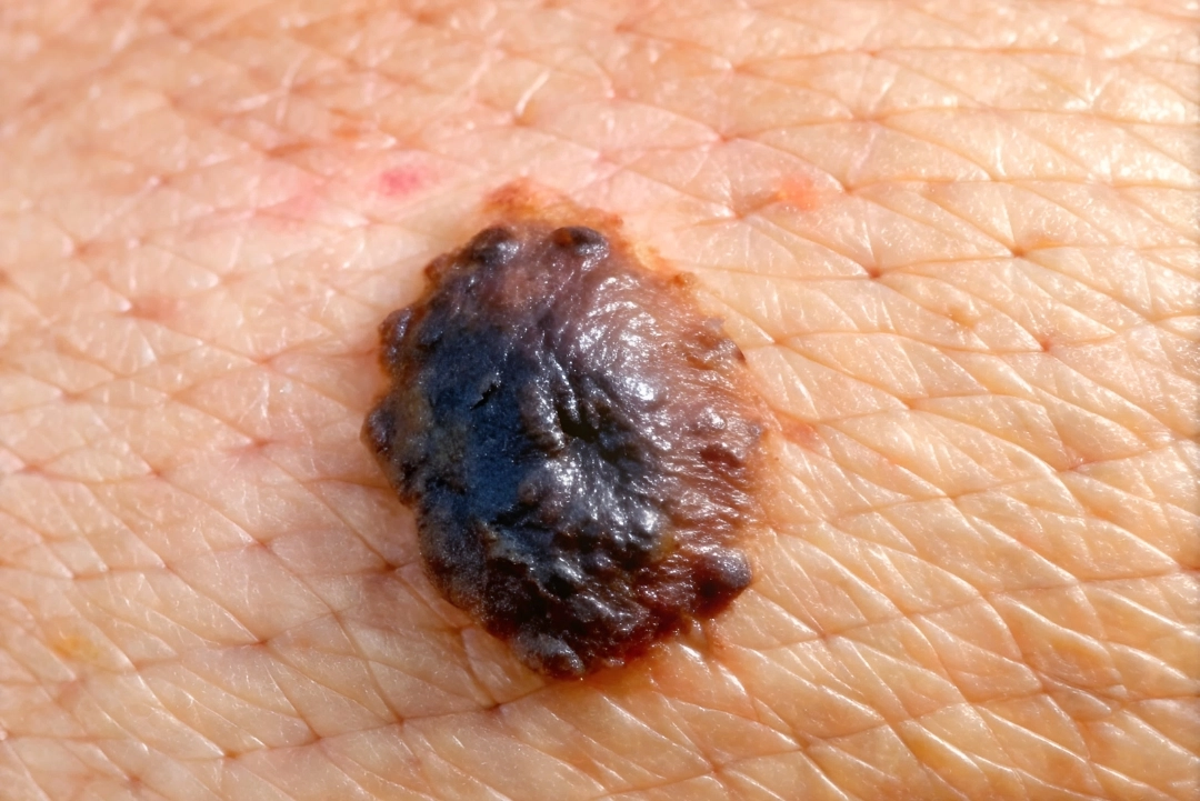 Carcinoma treatment